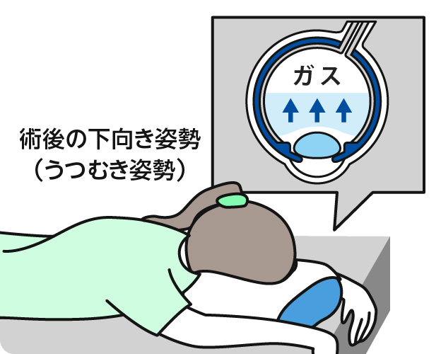 術後の下向き姿勢（うつむき姿勢）