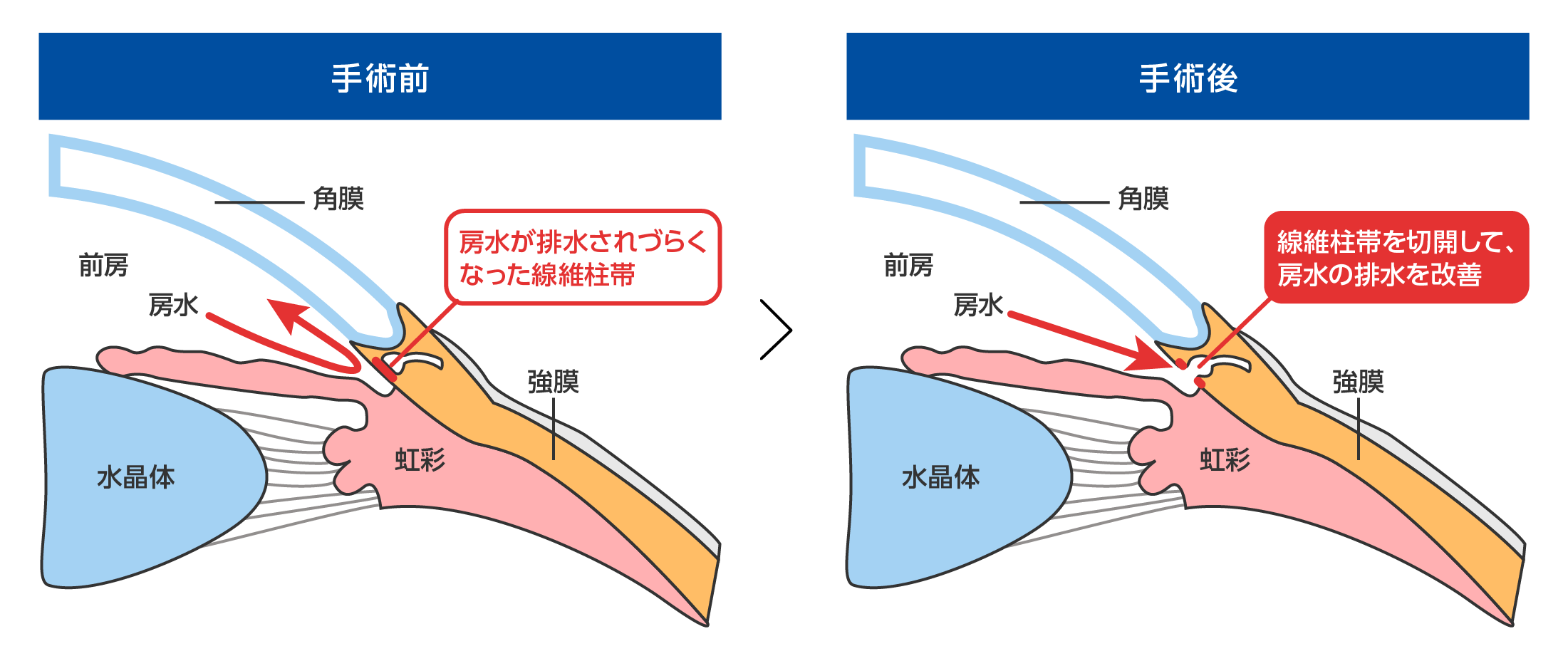 線維柱帯切開術(眼内法)