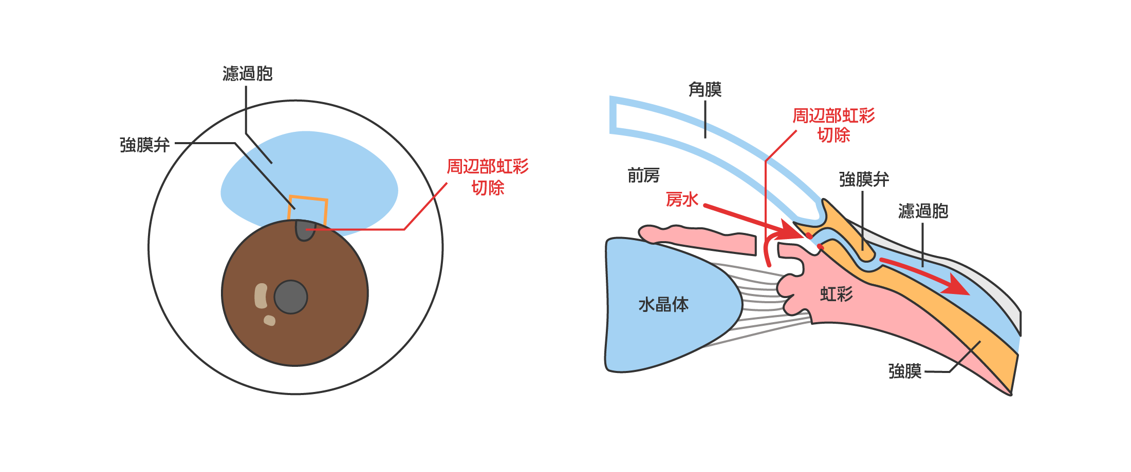 線維柱帯切除術(トラベクレクトミー)
