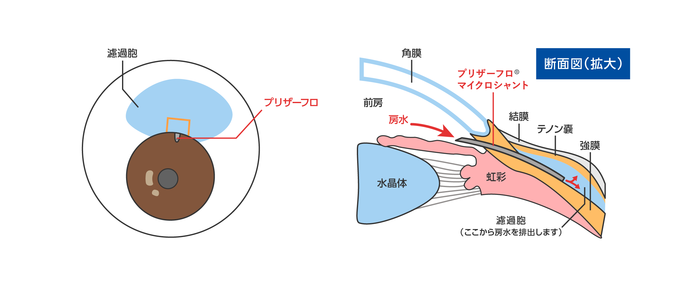プリザーフロマイクロシャント
